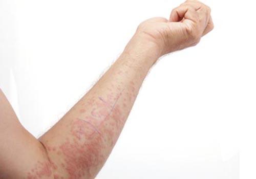 得了湿疹能吃蒜吗(湿疹不能吃蒜)