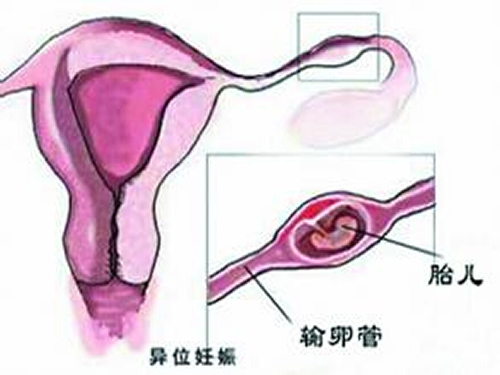 宫外孕是怎么引起的（宫外孕是怎么引起的原因是什么）