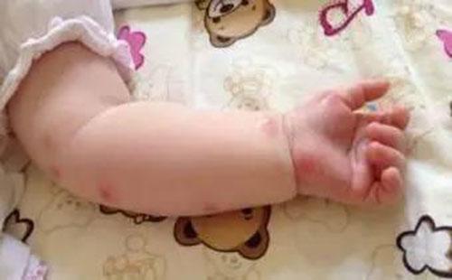 荨麻疹有什么危害 长期荨麻疹有什么危害