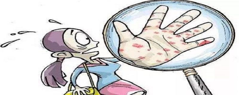 带状疱疹艾灸哪些部位（带状疱疹艾灸哪里）