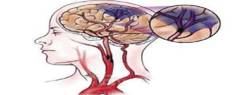脑梗死是什么病（间歇性脑梗死是什么病）