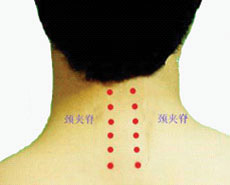 颈椎病针灸穴位图 颈椎病针灸的位置图片