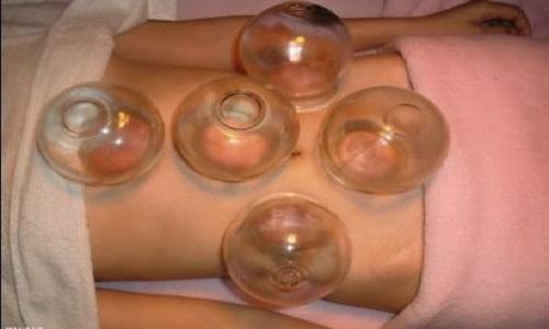 拔罐对腰肌劳损有用吗 拔罐腰肌劳损真的有效吗