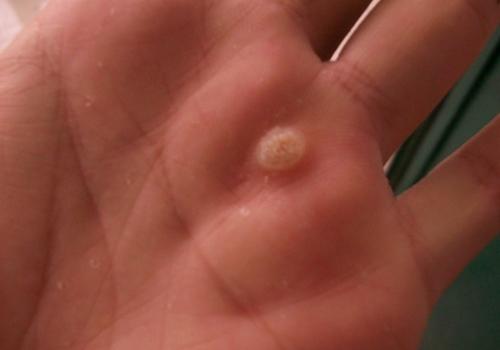 鱼痣会传染给别人吗（鱼痣会不会传染给别人）