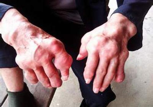 痛风人群适合吃什么（痛风人群适合吃什么食物）