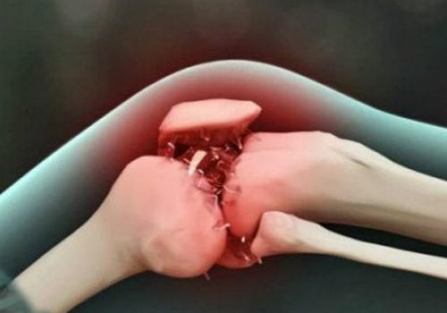 骨关节炎分类（骨关节炎分类 骨吸收型 增生型）