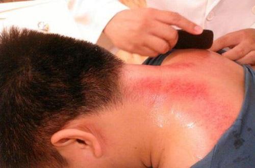 刮痧可以降血压吗（刮痧可以降血压吗百度百科）