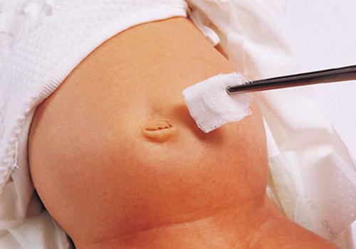 宝宝脐带消毒用酒精还是碘伏 宝宝脐带用什么消毒用酒精还是碘伏