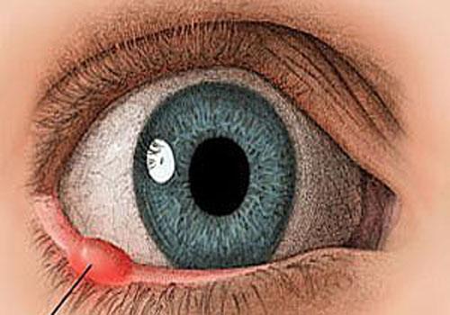 结膜炎和麦粒肿的区别（结膜炎和麦粒肿的区别图片）