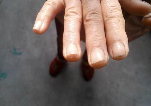 灰指甲擦醋有效果吗（灰指甲可以涂醋吗）