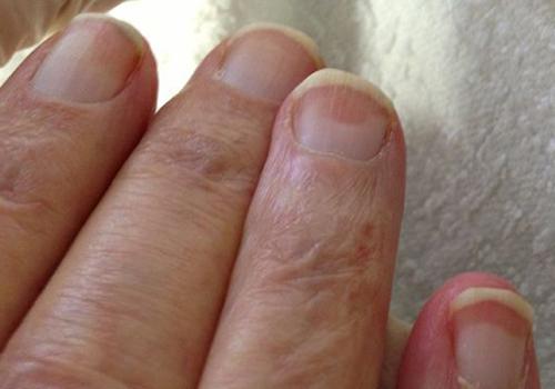 林赛氏指甲会有脚趾甲吗（林赛氏指甲百度百科）