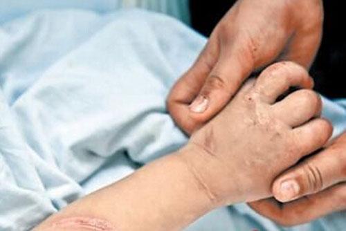 烫伤怎么才能不留疤痕 烫伤怎么才能不留疤痕抹什么东西