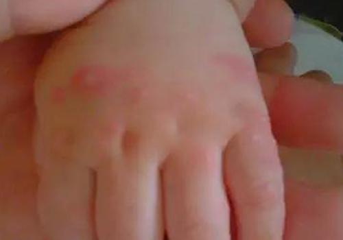 小儿手足口病能自愈吗（小儿手足口病能治愈吗）