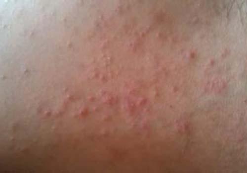 得了湿疹可以吃鸡蛋吗 得了湿疹不能吃鸡蛋吗