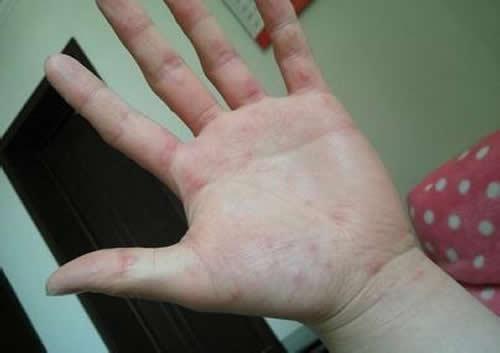 手心痒有红点是怎么回事（手心痒还有红点怎么回事）