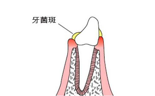 牙周炎是什么原因引起的 牙周炎是什么原因引起的怎样防治