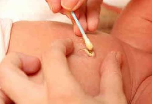 新生儿脐炎的护理措施 新生儿脐炎的护理诊断及措施