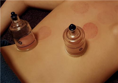 拔罐拔出血是怎么回事（拔罐拔出血咋回事）