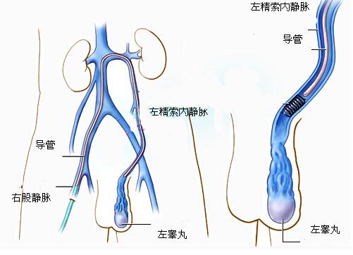 老怀不上竟是因为精索静脉曲张（为什么医生说精索静脉曲张不用治）