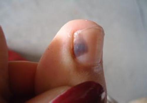 打球脚趾甲淤血怎么办（打完球脚趾甲淤血）