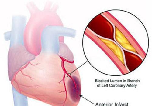 心肌梗塞是怎么造成的