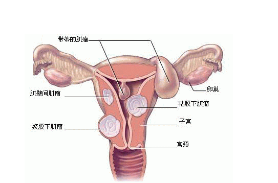 子宫肌瘤常见并发症