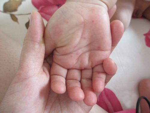 手足口病为什么会复发（手足口病还会不会复发）