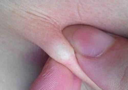 脂肪瘤疼痛是怎么回事 肋间脂肪瘤疼痛是怎么回事