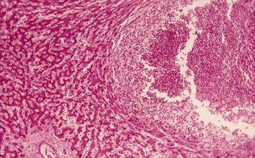 肝脓肿是怎么引起的（肝脓肿是怎么引起的呢）