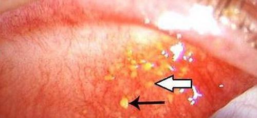 上眼皮里面长了个小白点是怎么回事 上眼皮里长了一个小白点是什么