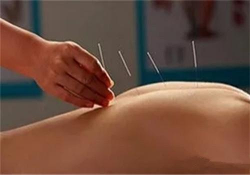 针灸减肥效果好吗（针灸减肥效果好吗知乎）