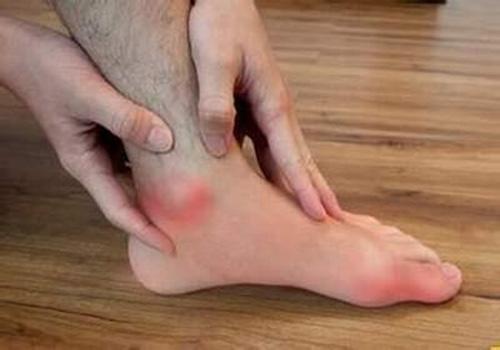 痛风会引起哪些并发症 痛风会引起哪些并发症及症状