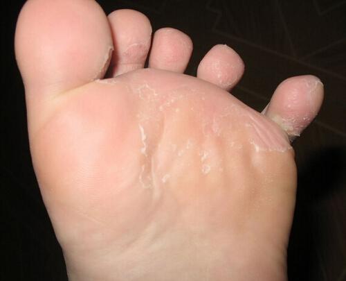 指甲缝痒是什么原因（总是觉得指甲缝痒是怎么回事）