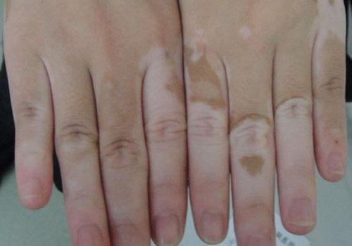 白斑风有什么症状（怎么判断身上的白斑不是白风）