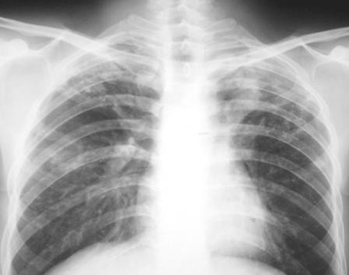肺癌拍片能查出来吗 肺癌拍片子能查出来吗
