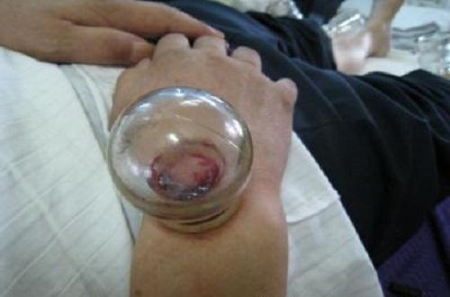 手臂拔罐位置示意图（胳膊拔罐位置示意图）