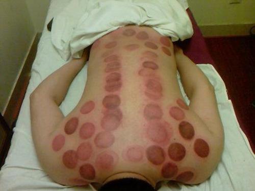 拔罐的作用 拔罐的作用与功效