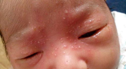 眼部扁平疣和脂肪粒的区别（眼角疣和脂肪粒区别）