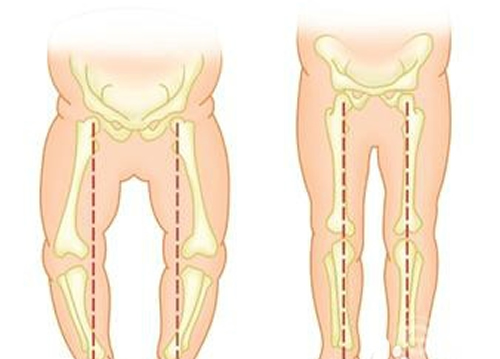 婴儿O型腿如何判断（婴儿o型腿怎么判断）