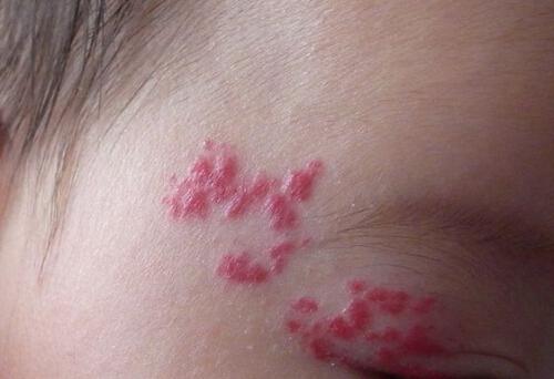 血管瘤吃什么好（动脉血管瘤吃什么好）