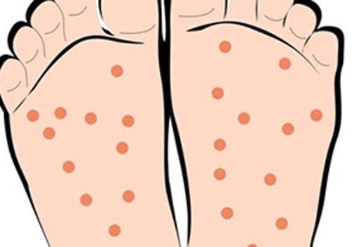 小孩手足口病起疹子吗（婴儿手足口病全身起疹子正常吗）
