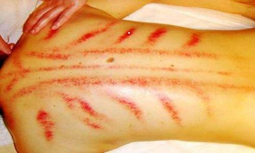 刮痧对感冒有什么作用（感冒可以刮痧吗刮痧有利于感冒吗）