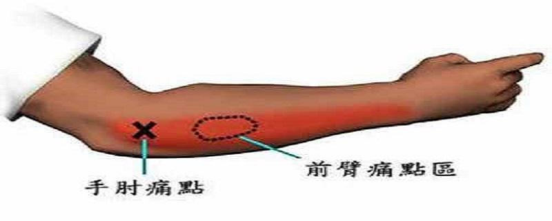 网球肘艾灸要哪个位置（网球肘艾灸哪个部位）