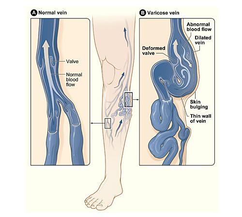 下肢静脉曲张有什么危害 下肢静脉曲张有什么危害吗?该怎么治疗