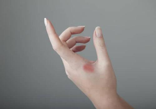 夏天烫伤要包扎吗 夏天烫伤要包扎吗图片