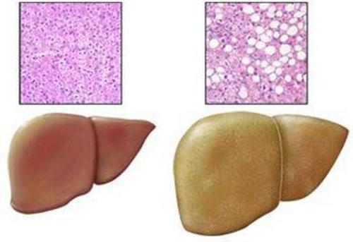 脂肪肝的危害及防治（脂肪肝的危害及治疗）