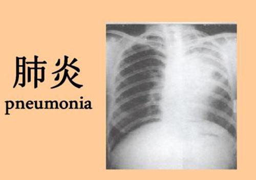 肺炎和感冒的区别(肺炎和感冒的区别方法)