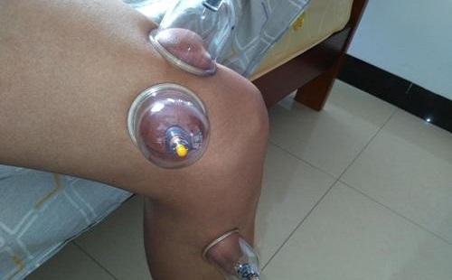 膝盖拔罐具体位置图 膝盖拔罐具体位置图图片