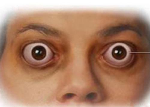 甲亢对身体有什么危害 女人得了甲亢对身体有什么危害