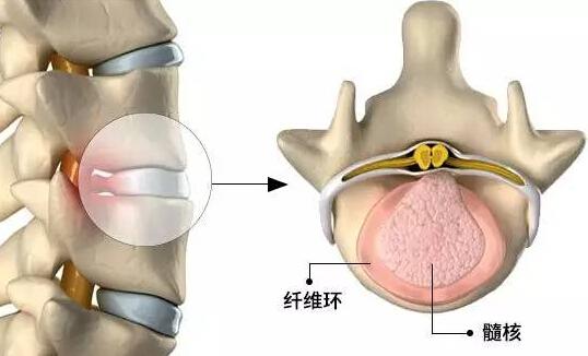 关于椎间盘突出，你必须知道的知识 关于椎间盘突出,你必须知道的知识是